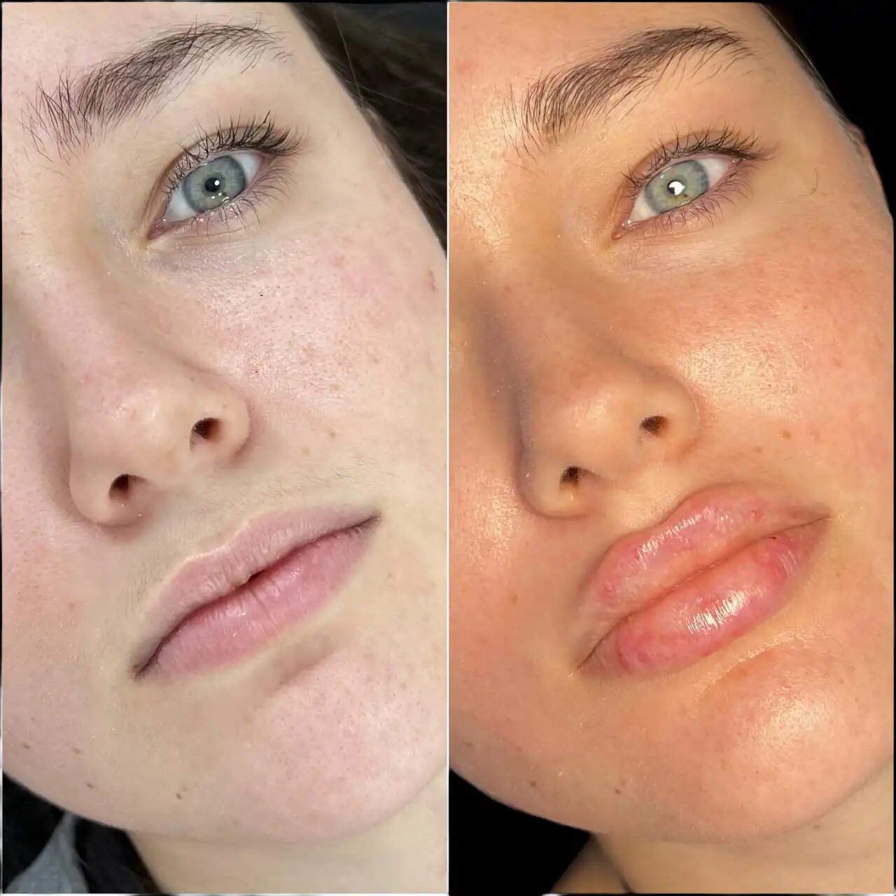 Why More People Are Choosing Fillers Treatment in Dubai